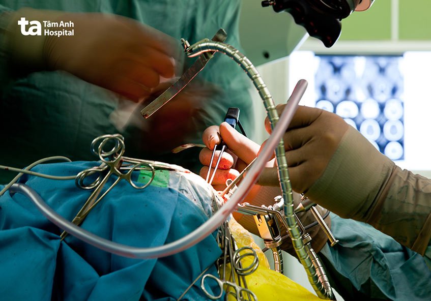 Bác sĩ có thể chỉ định phẫu thuật điều trị dị dạng mạch máu não