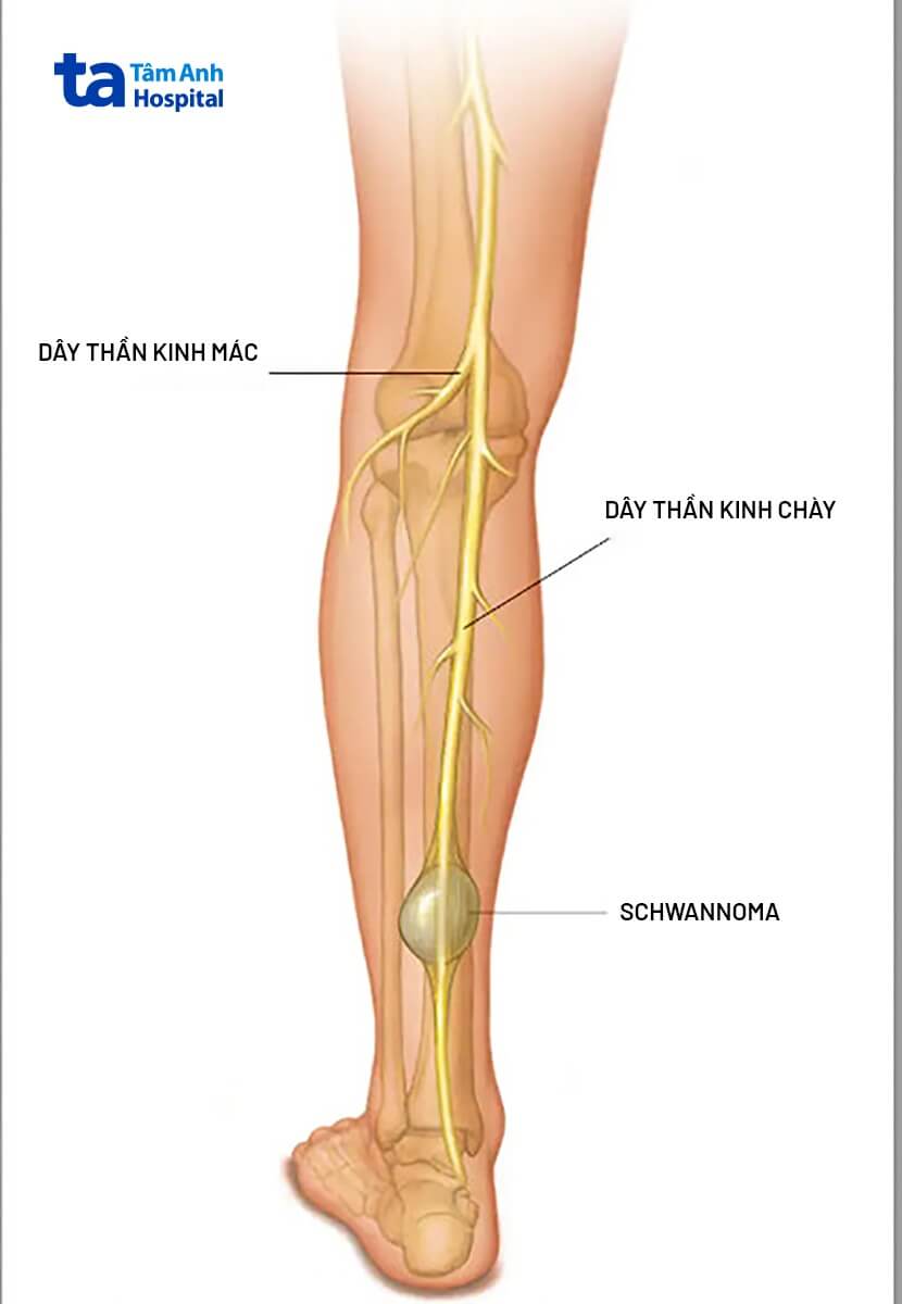 bệnh schwannoma