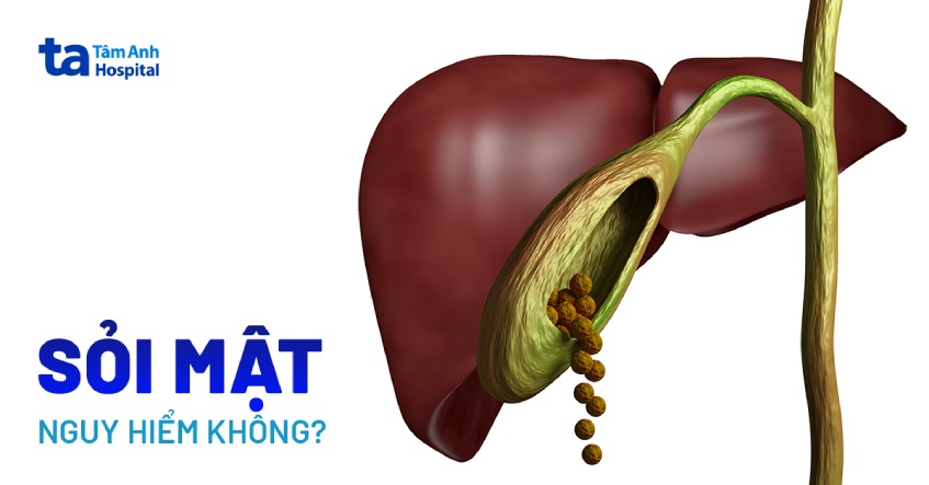 bệnh sỏi mật có nguy hiểm không