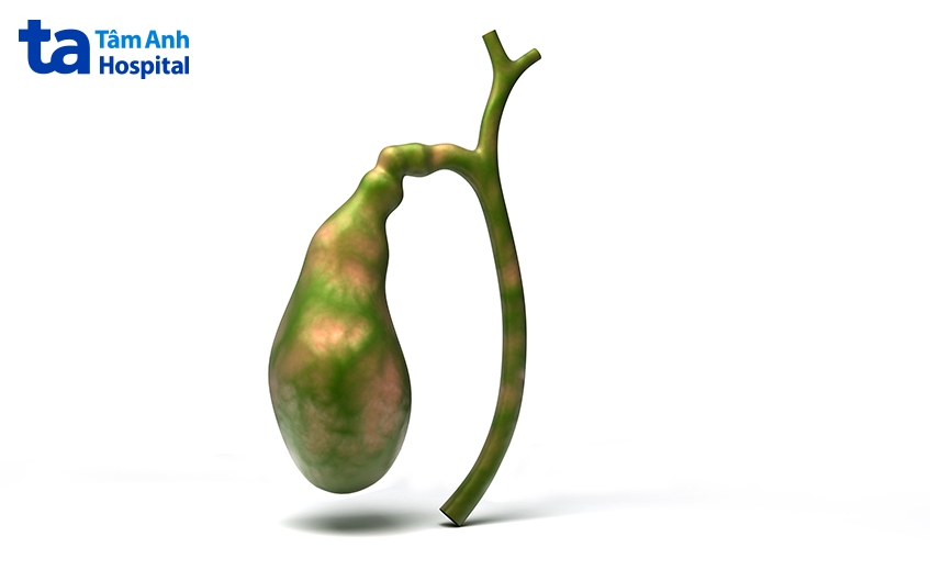 bị viêm túi mật