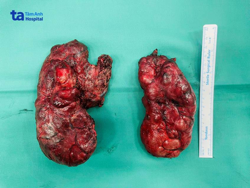 Bướu cổ khổng lồ