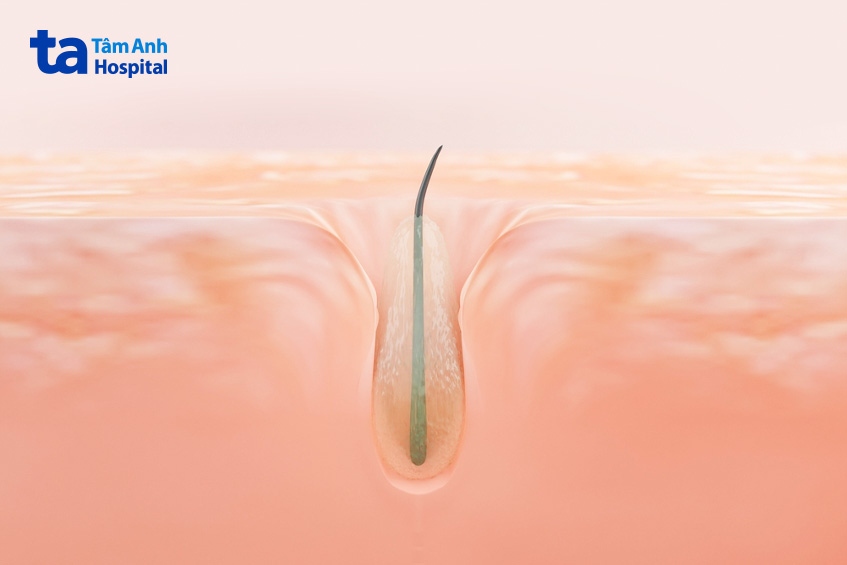 Lỗ chân lông bị bít tắc khiến mụn cám hình thành