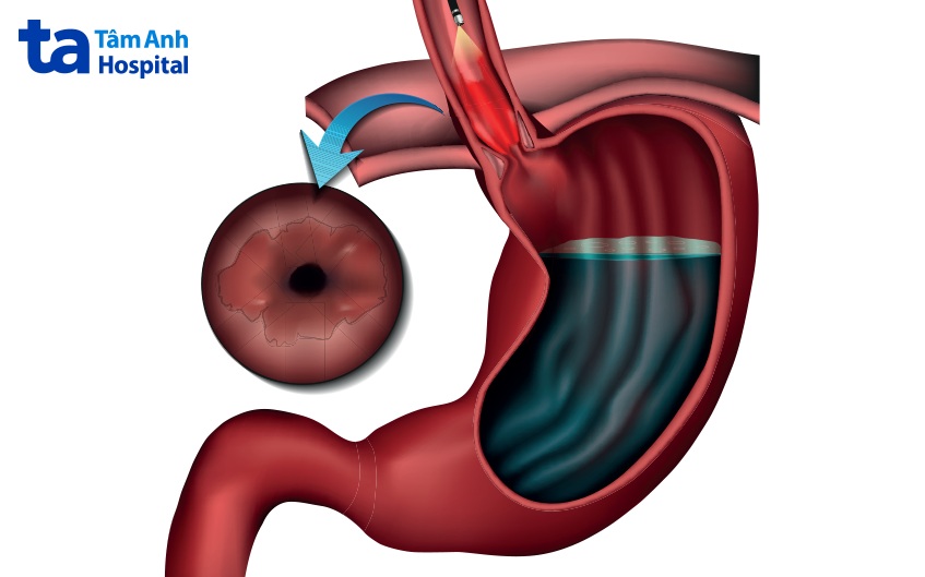 chẩn đoán barrett thực quản