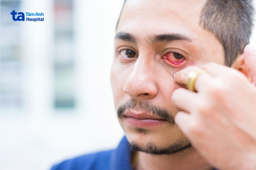 cách siêu âm mắt