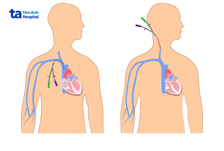 Catheter lọc máu