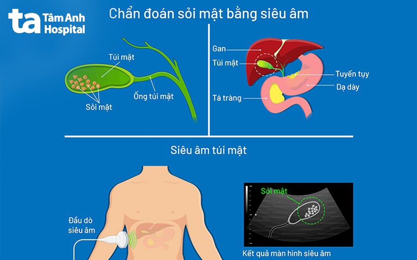 chẩn đoán bệnh sỏi mật