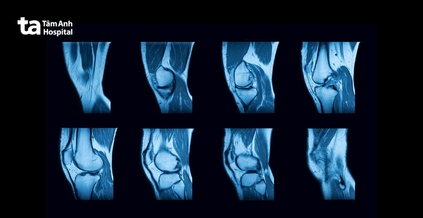 chẩn đoán bệnh viêm dây thần kinh ngoại biên