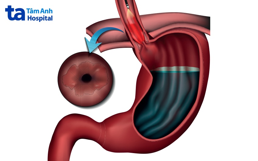 chẩn đoán loét thực quản