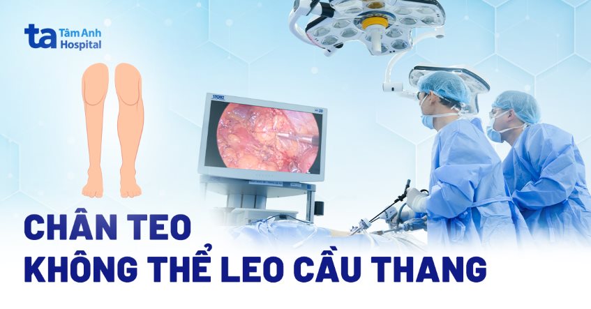 Chân teo không thể leo cầu thang