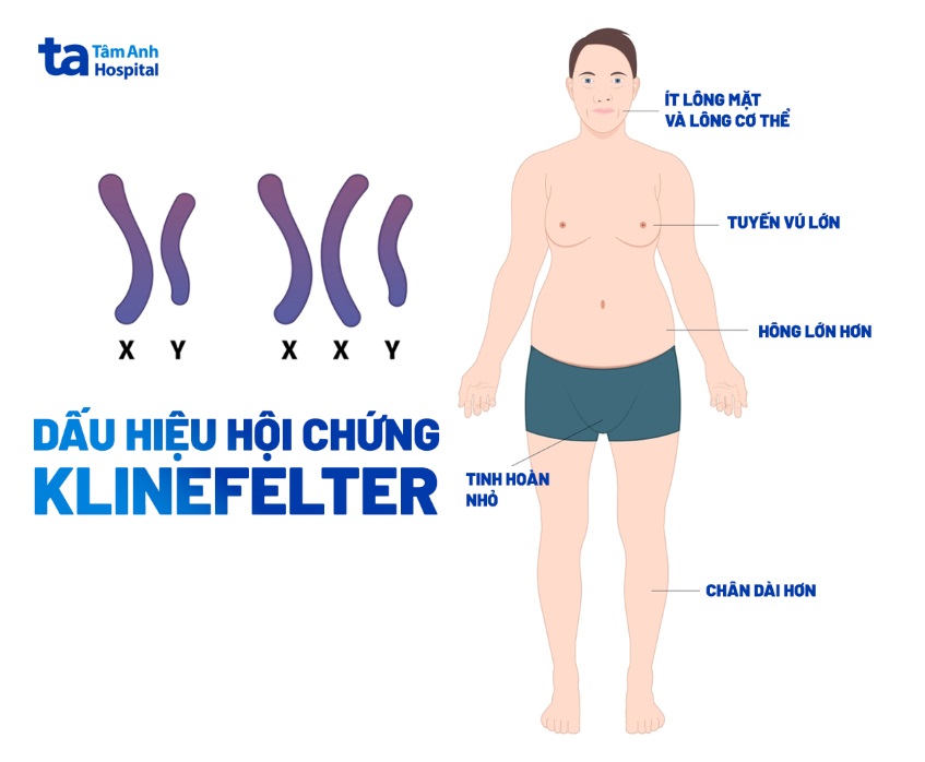 Dấu hiệu hội chứng Klinefelter