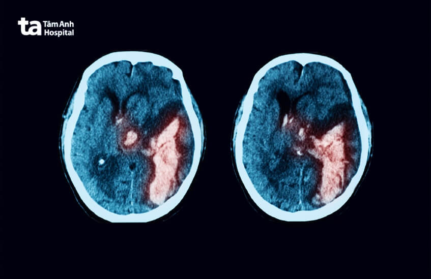 di chứng chấn thương sọ não