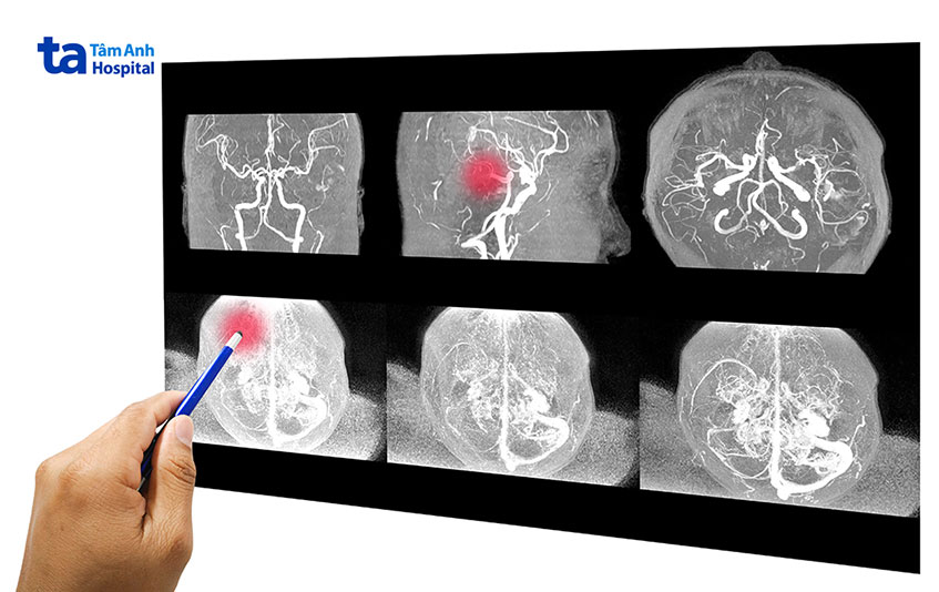 Dị dạng mạch máu não có thể gây xuất huyết não