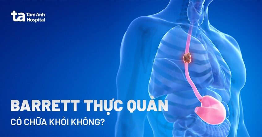 điều trị barrett thực quản