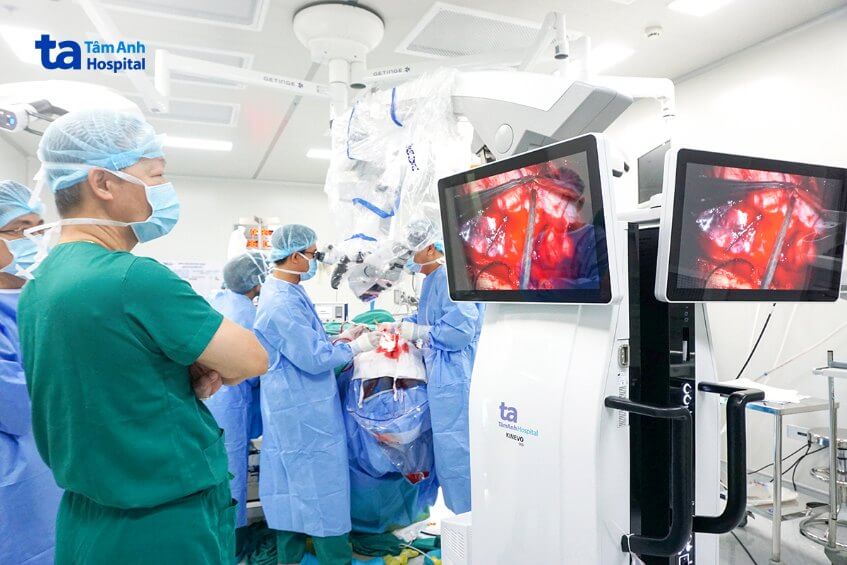 điều trị u thần kinh đệm bậc thấp