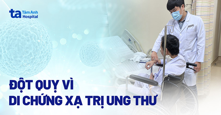 Đột quỵ do di chứng xạ trị ung thư