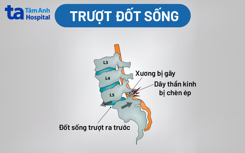đốt sống bị trượt
