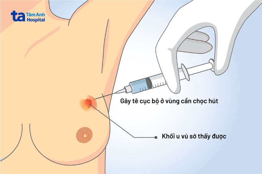 fna tuyến vú là gì