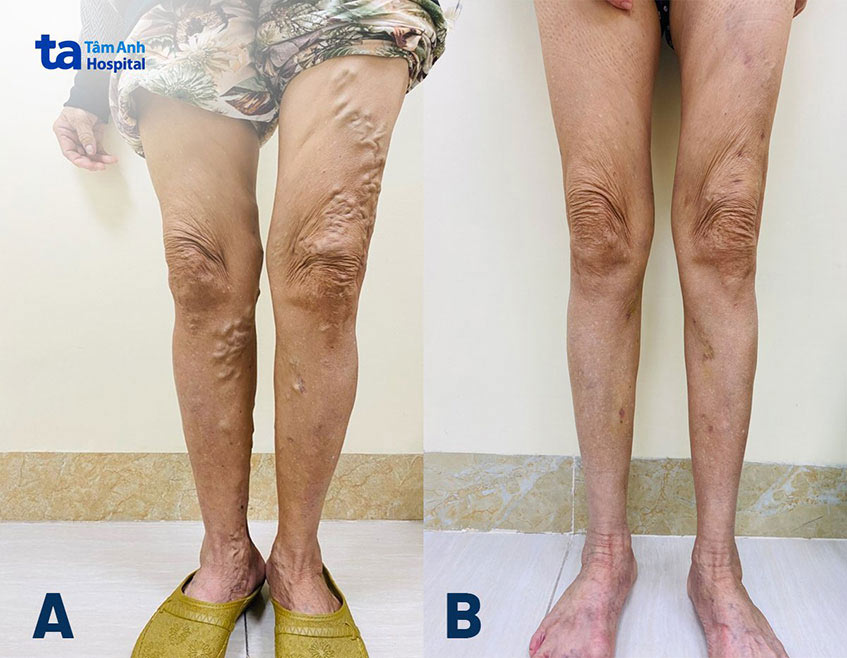 Hai chân bệnh nhân nổi các búi tĩnh mạch (hình A) và sau khi được điều trị đốt laser (hình B)