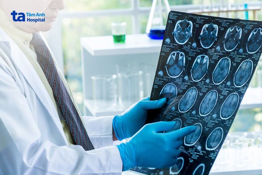 hình ảnh chẩn đoán u thần kinh đệm cầu não lan tỏa