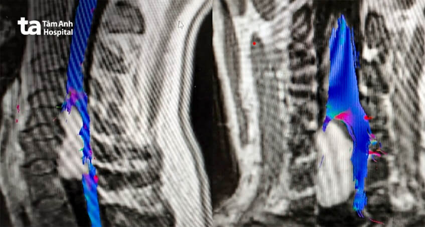 hình ảnh khối u tủy sống