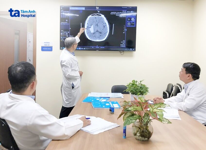 hội chẩn điều trị đột quỵ xuất huyết não
