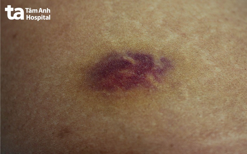 khối máu tụ ngực