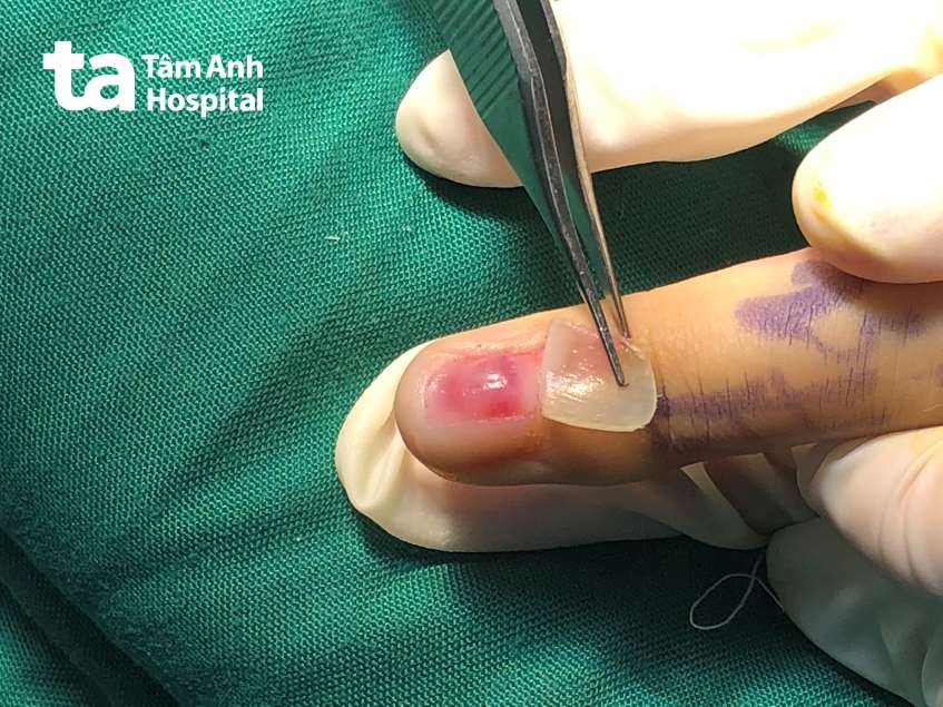 khối u phát triển trên ngón tay