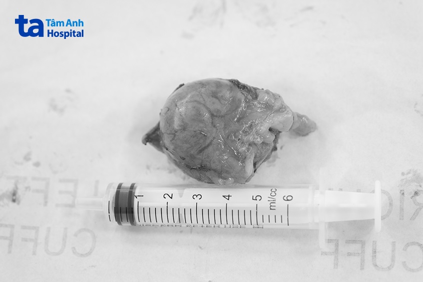 khối u tuyến thượng thận