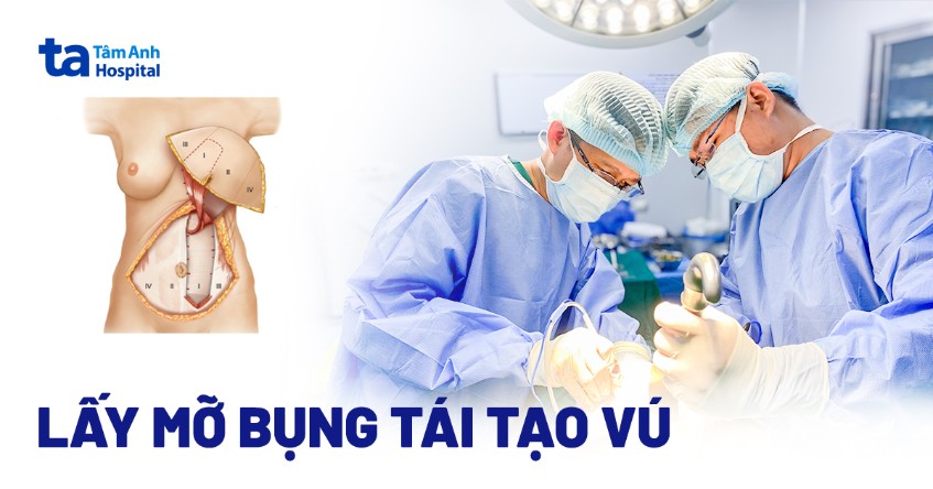 Lấy mỡ bụng tái tạo vú cho bệnh nhân