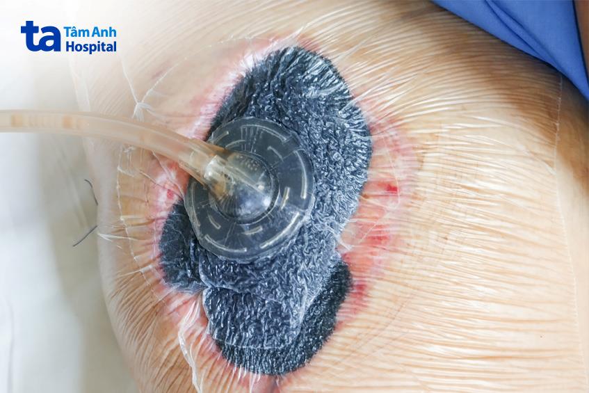 Máy hút áp lực âm