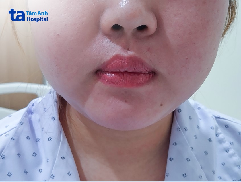 Mỡ bị tích ở mặt 