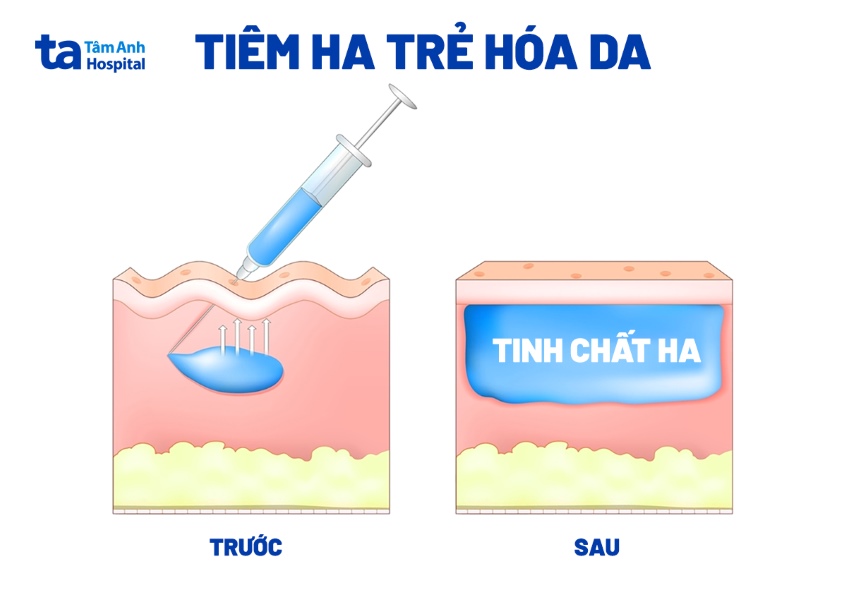 Mô phỏng tiêm HA