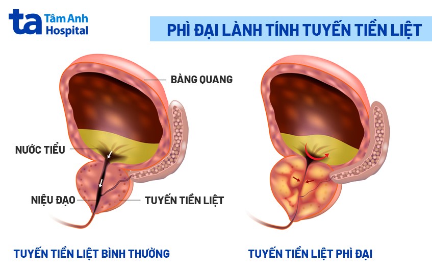 mô phỏng tuyến tiền liệt