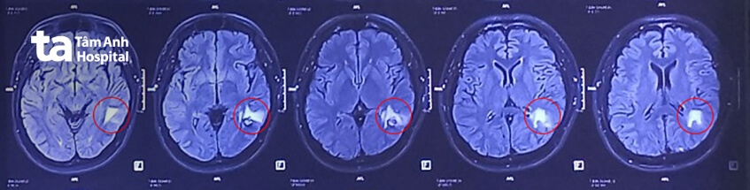 mổ u mạch máu não sau 7 năm từ chối kết quả mri