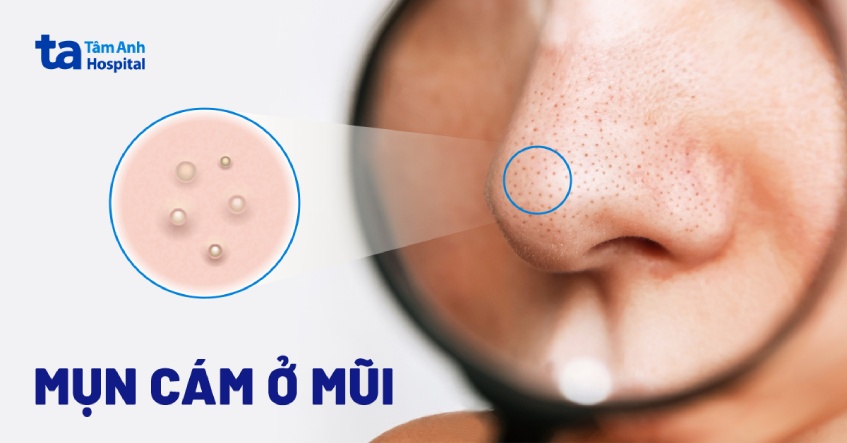 Mụn cám ở mũi: Nguyên nhân, dấu hiệu, chẩn đoán, phòng ngừa