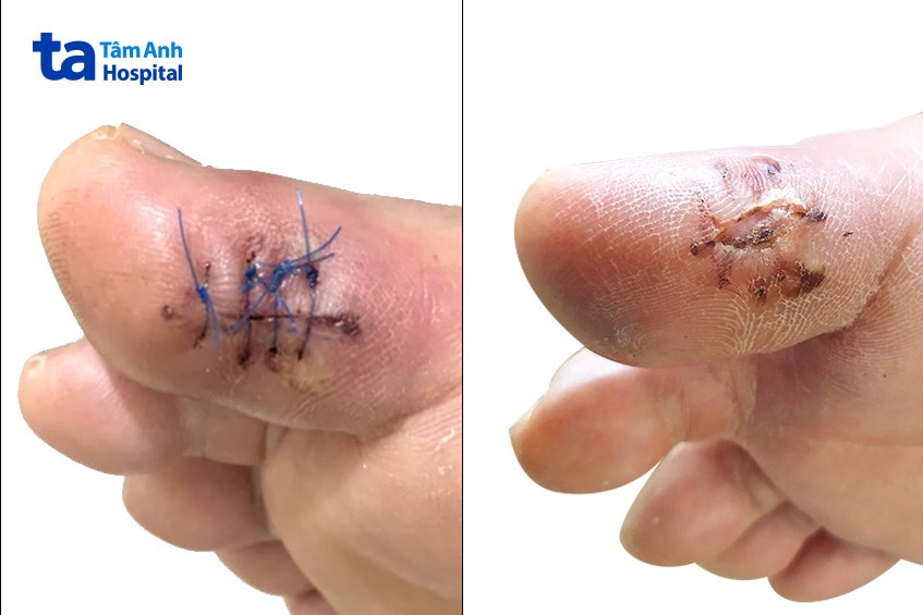 Ngón chân bệnh nhân sau điều trị