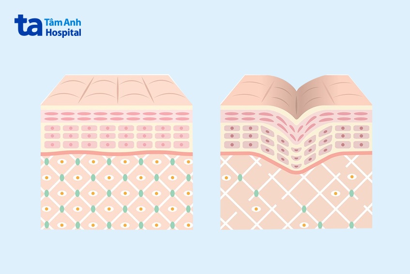 nguyên nhân khiến da bị chảy xệ