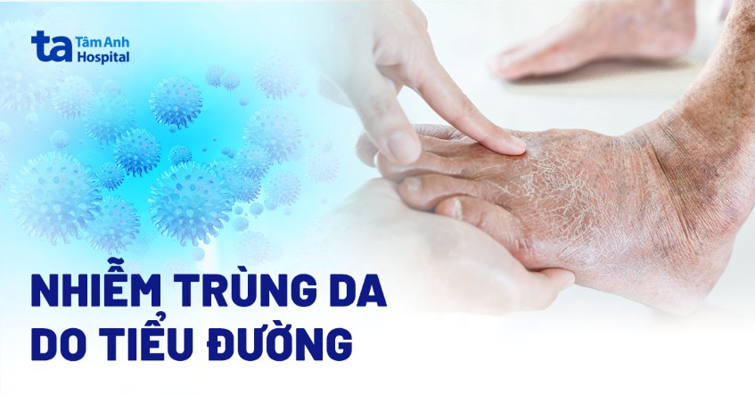 Nhiễm trùng da, áp xe trong cơ ở bệnh nhân đái tháo đường