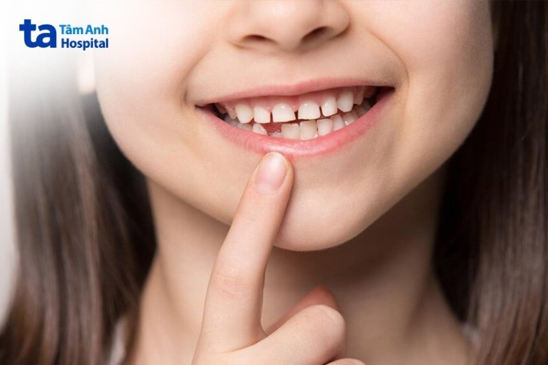 Tại sao phải nhổ răng sữa?