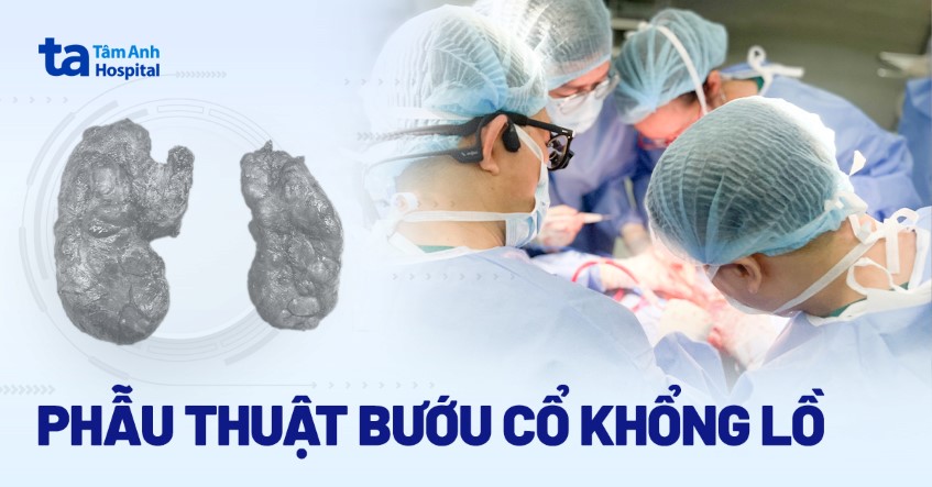 Phẫu thuật bướu cổ khổng lồ