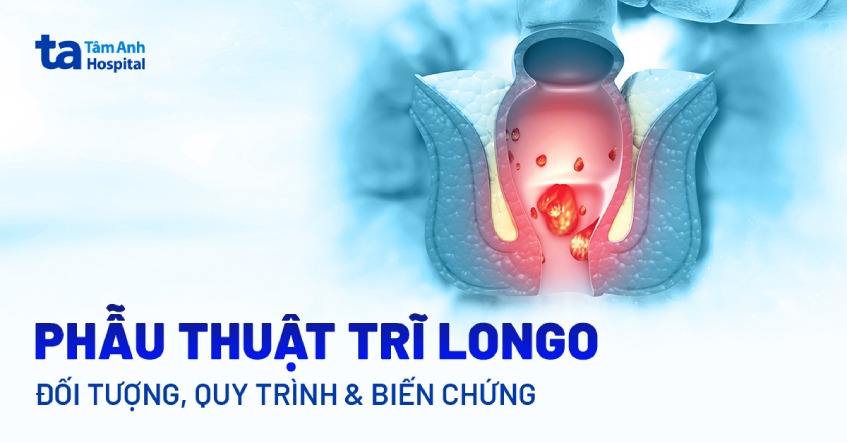 phẫu thuật cắt trĩ bằng longo