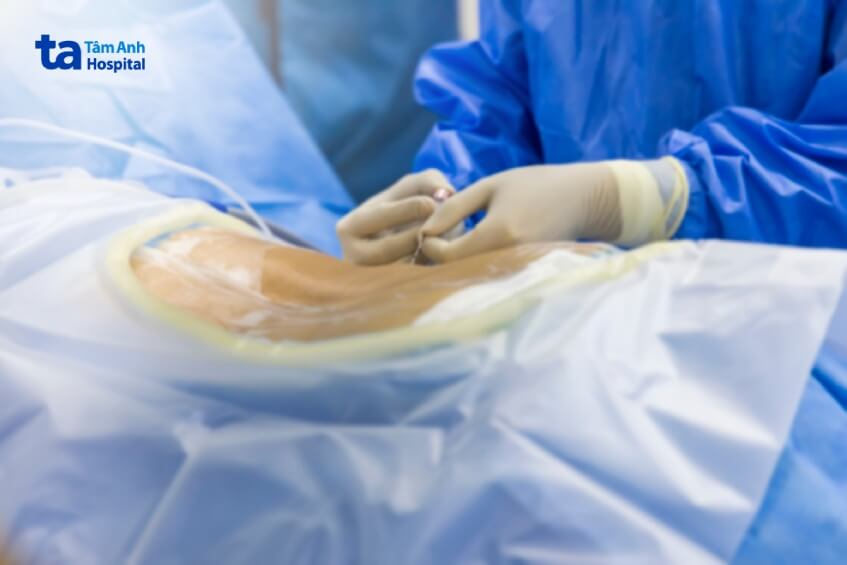 phẫu thuật khối u tủy sống