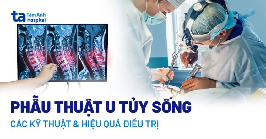 Phẫu thuật u tủy sống: 2 phương pháp phổ biến và lưu ý