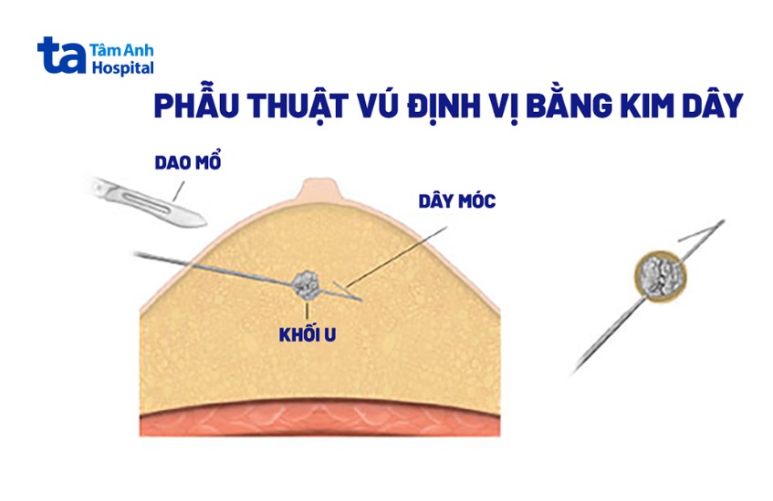 phương pháp định vị kim dây móc vú