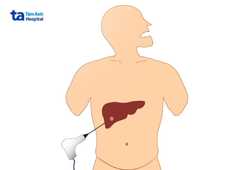phương pháp đốt sóng cao tần rfa