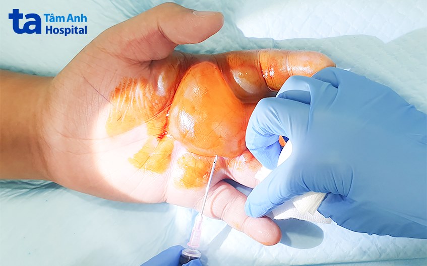 Sát trùng và xử lý bóng nước do bỏng lạnh