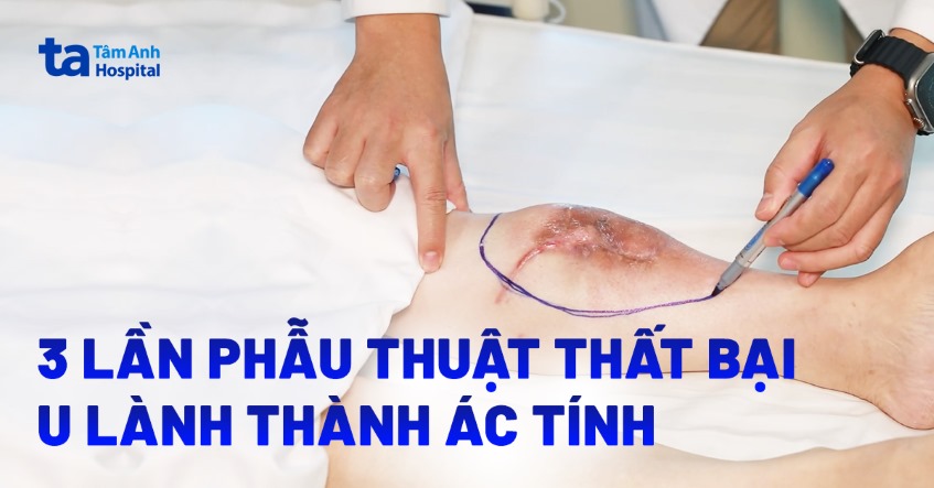 3 lần phẫu thuật thất bại, u lành thành ác tính