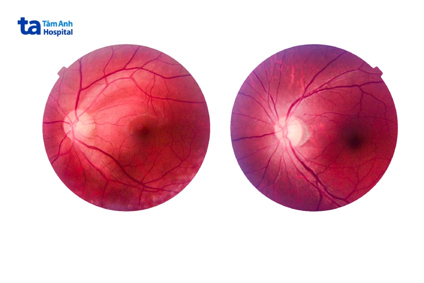 siêu âm mắt để làm gì