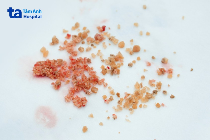 Sỏi được tán vụn và đưa ra ngoài