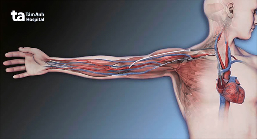 Thiết bị HeRO graft